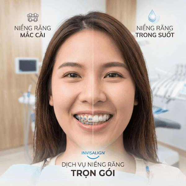 Niềng Răng